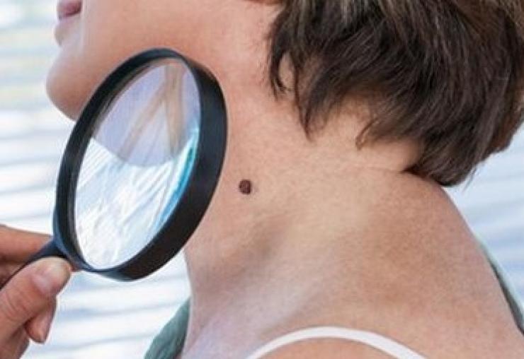 melanoma